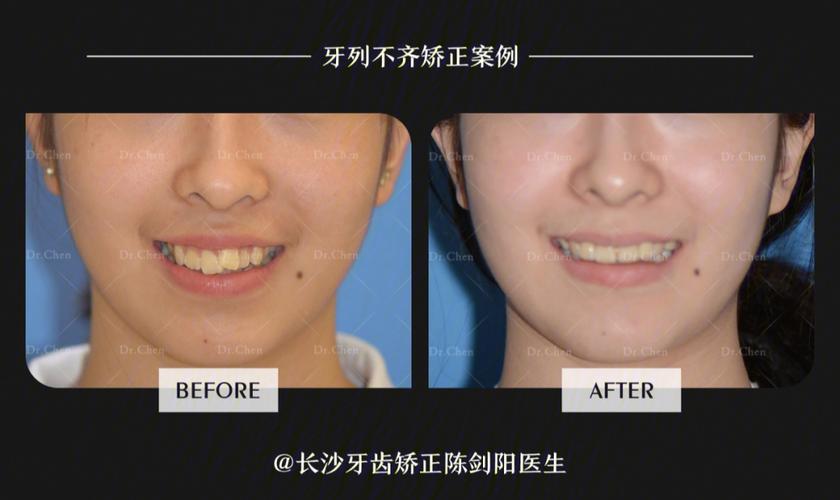 重庆拔门牙矫正牙齿会松动吗？正畸医生说出大实话
