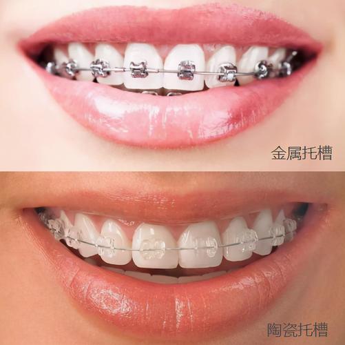 重庆深圳深覆合矫正价格大揭秘