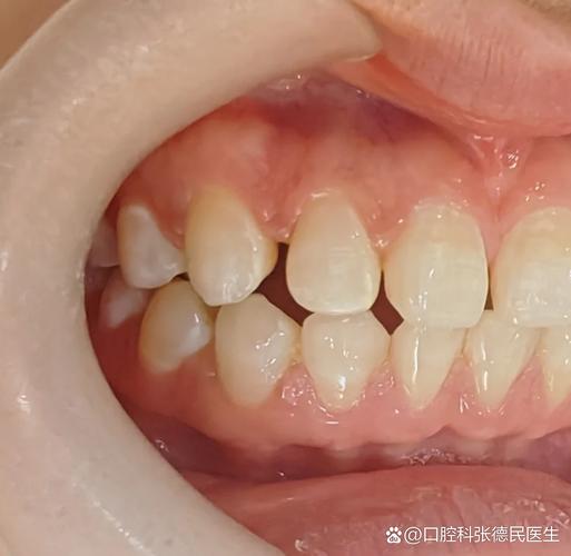 重庆深圳牙缝过大矫正多少钱？最新价格一览