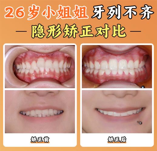 重庆北京舌侧矫正靠谱吗？价格/医院/医生全揭秘