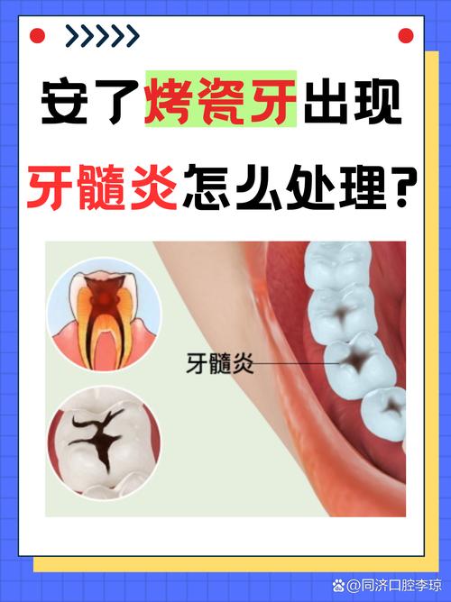 重庆牙医良心忠告：做烤瓷牙前这两点不注意，当心毁了整口牙