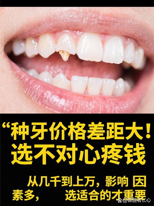 重庆种植牙再等5年爆发？价格已降，技术更微创，缺牙患者有福了