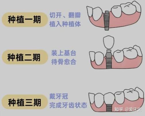重庆杭州种植牙骨粉贵不贵？要补多少？