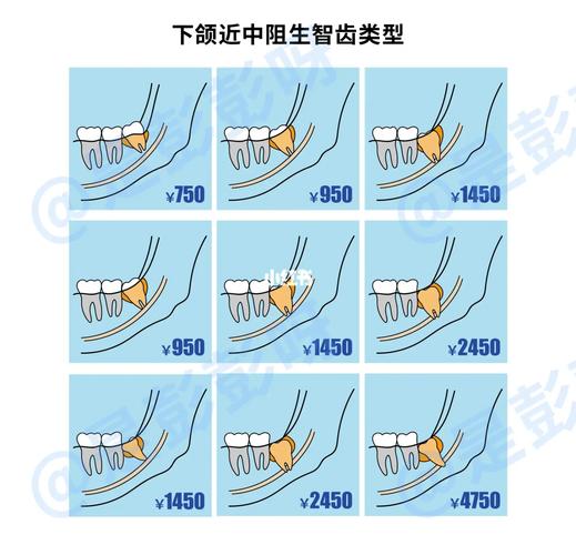 重庆杭州口腔医院拔牙要花多少钱？怎么选才不踩坑？