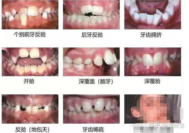 重庆青岛儿童几岁做正畸最好？多少钱？