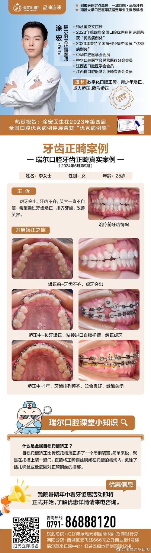重庆成人龅牙矫正选医院还是诊所？关键看医生资质和案例对比