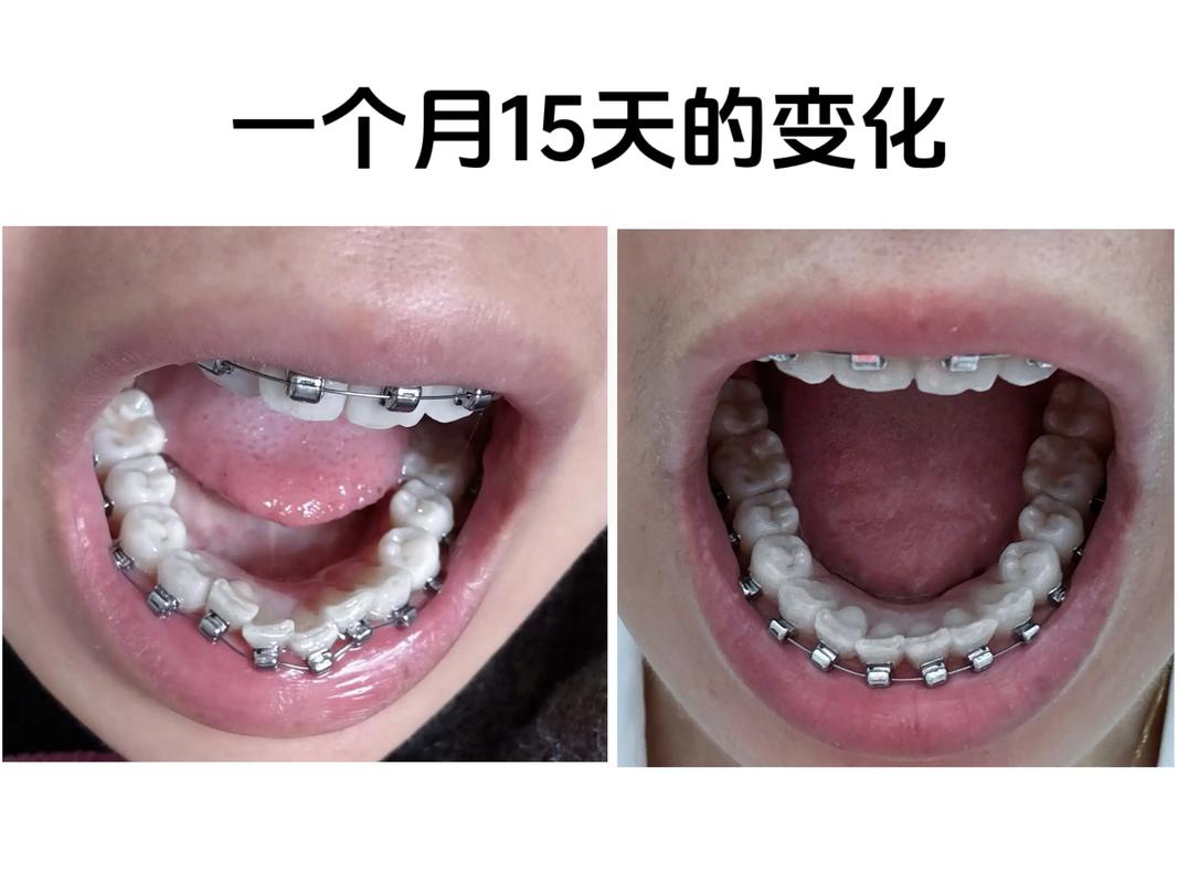 重庆50岁还能矫正牙齿吗？中年正畸真实效果与风险解析