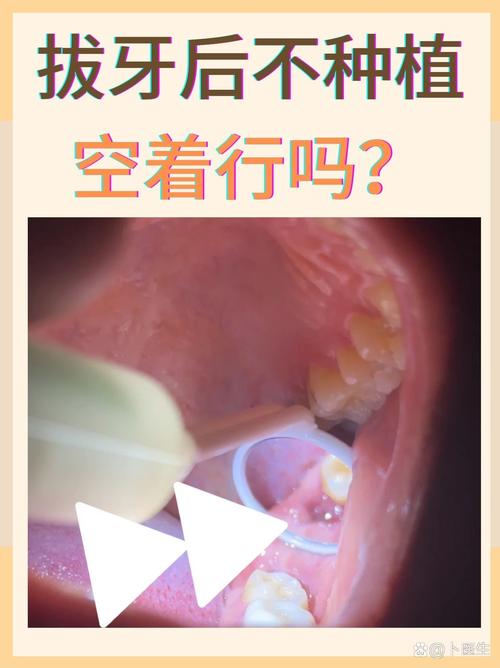 重庆成人拔牙后必须种牙吗？不种牙的后果，医生告诉你真相