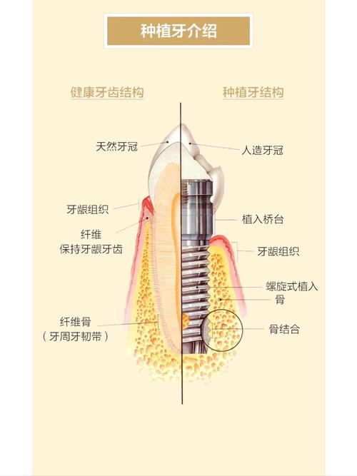 重庆什么叫种植牙齿 一篇讲清原理过程