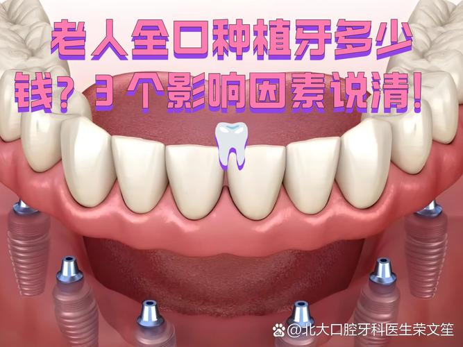 重庆沙井全口种植多少钱？要种几颗？一次说清