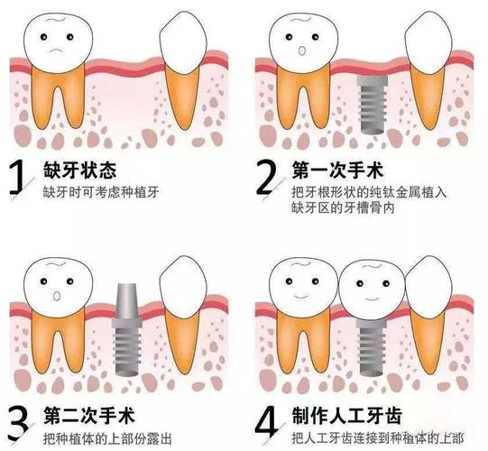重庆上海种植牙全过程揭秘：从挂号到戴牙多久？
