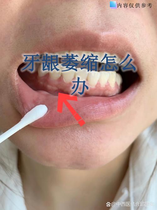 重庆缺牙不补的严重后果：邻牙倾斜松动，对牙伸长，牙槽骨萎缩
