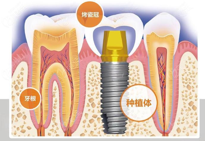 重庆赤峰种牙费用详解：从预算到效果，给您的实惠指南