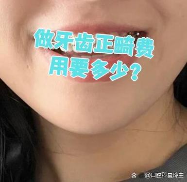 重庆深圳福田青少年钢丝矫正牙齿要花多少钱