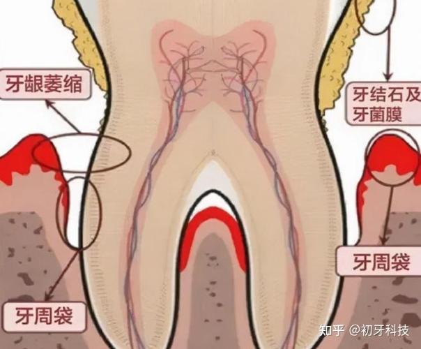 重庆贵阳种植牙2026年单颗3500到5500元贵吗