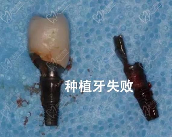 重庆种植牙失败了怎么办？修复费用到底要多少？