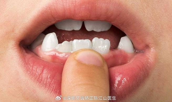 重庆小孩牙齿长成锯齿状，到底严重不严重？