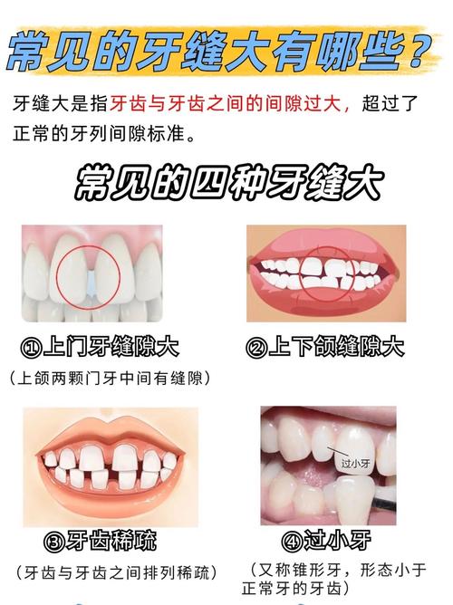 重庆矫正牙齿门牙缝隙变大了？医生告诉你正常吗咋应对