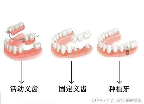 重庆北京种牙失败修复多少钱？游离体取出需花费多少？