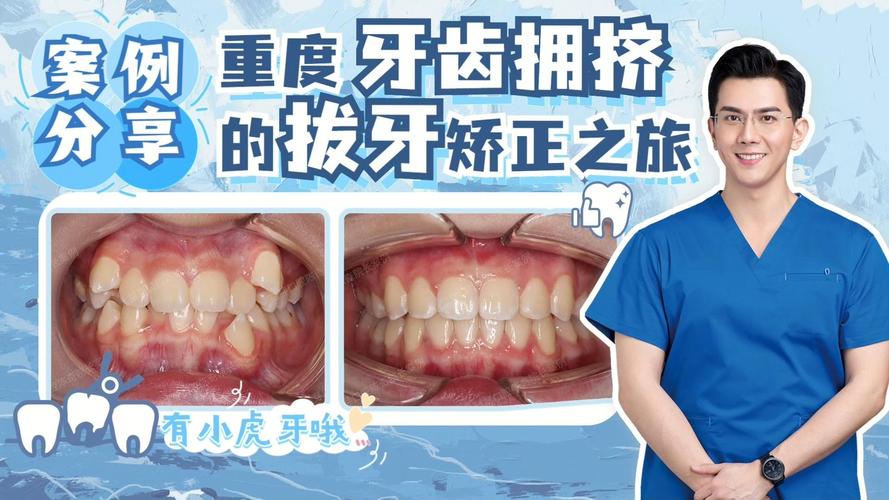 重庆告别“虎牙”尴尬，快速矫正重塑自信笑容