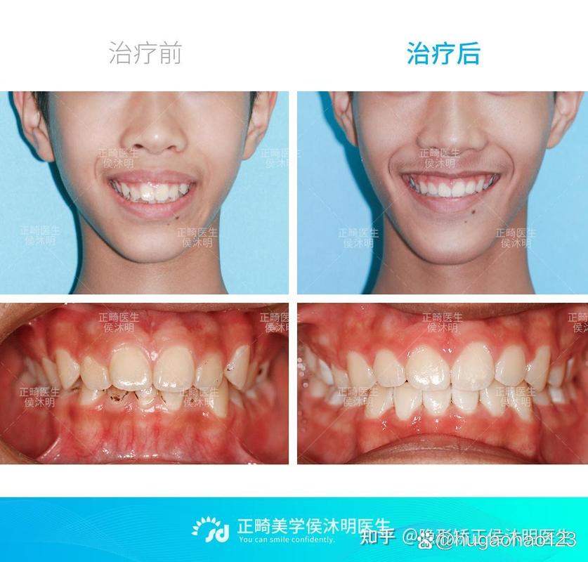 重庆25岁龅牙还能矫正吗？过来人分享真实经历