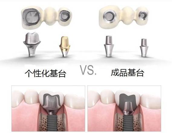 重庆缺牙后选进口还是国产种植体？到底哪个更划算？
