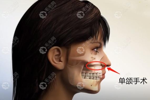 重庆深圳成人骨性龅牙矫正到底要花多少钱？