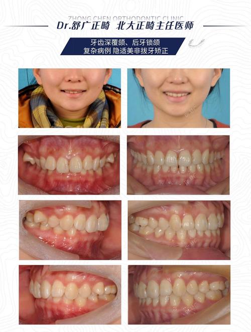 重庆30岁后矫正深覆合？成人正畸完全可行