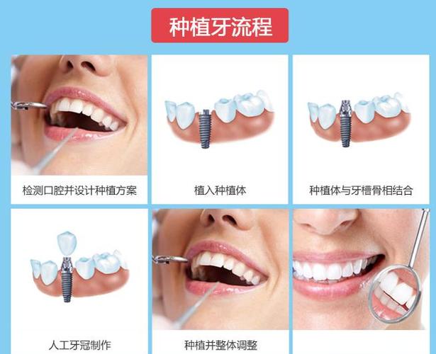 重庆深圳罗湖骨量不足全口种牙多少钱？费用明细来了
