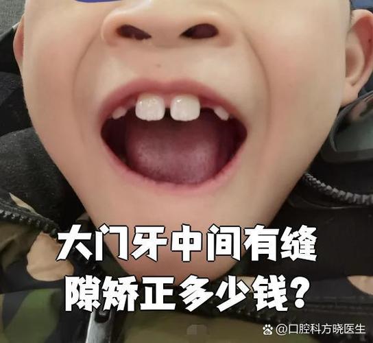 重庆矫正牙齿到底要花多少钱？2026年最新价格大揭秘