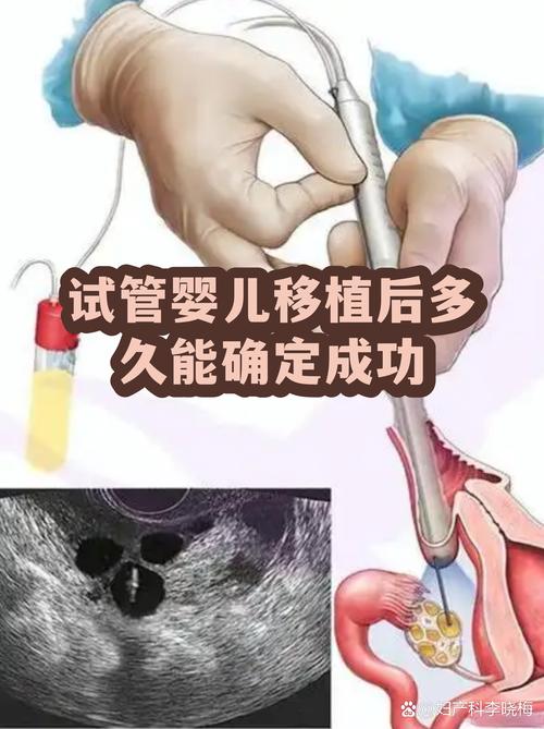 重庆一代试管婴儿能成功吗 看完心里有底