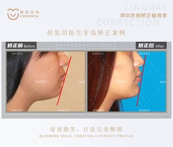 重庆为什么24岁做牙齿矫正效果更好