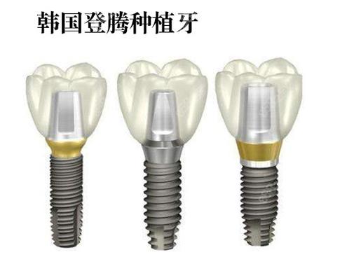 重庆株洲种牙哪家强？公立医院性价比之选