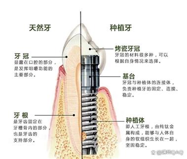 重庆深圳缺牙修复：镶牙与种植牙到底哪个更省钱？