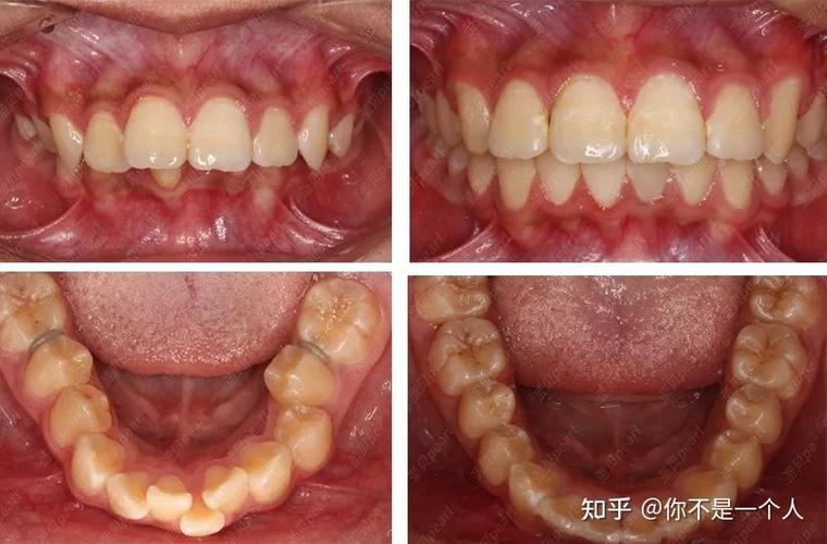 重庆27岁整牙晚不晚？揭秘成年正畸的真实效果与风险