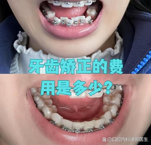 重庆宿迁牙齿矫正一般要花多少钱?