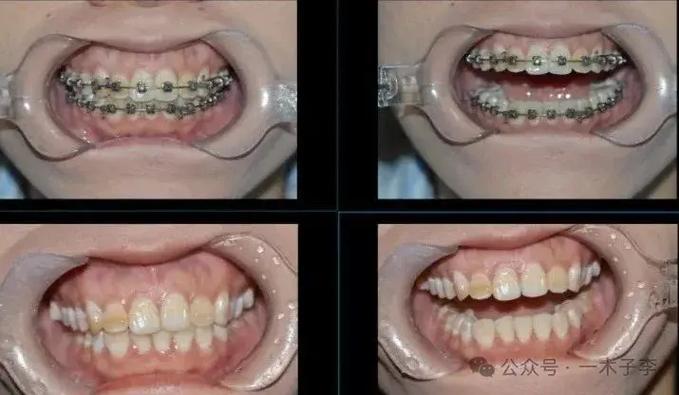 重庆30岁矫正牙齿有什么危害？把坑说透了再决定