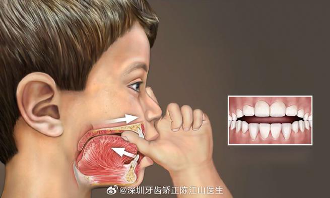 重庆深圳孩子地包天几岁治最好？牙医揭秘黄金期