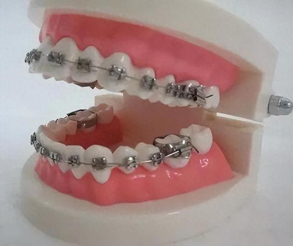 重庆35岁矫正牙齿还来得及吗?真实体验告诉你