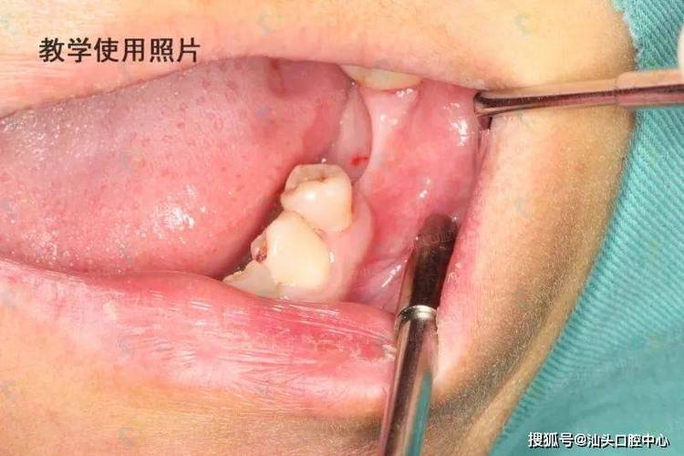 重庆没有牙骨也能种牙？医生说实话