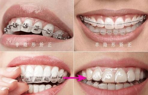 重庆25岁还能矫正牙齿吗？看完这篇不再纠结