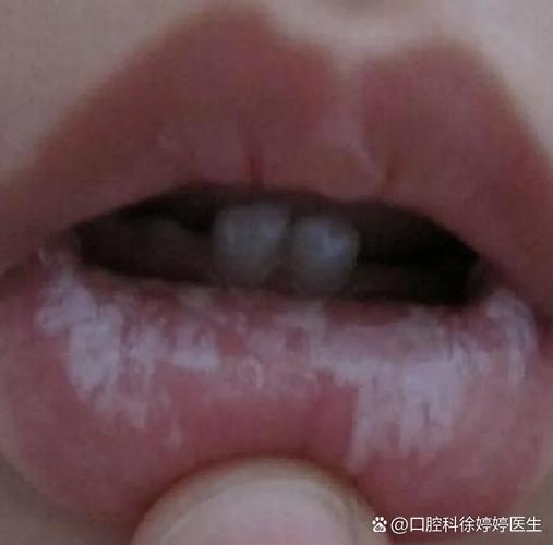 重庆儿童口腔有白色黏膜到底严不严重