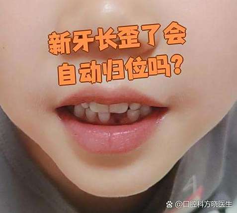 重庆六岁孩子门牙长歪先别慌 看这几种矫正办法