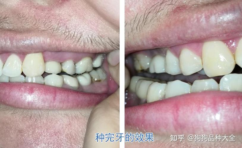 重庆赤峰种植牙哪里好 公立三甲靠谱推荐