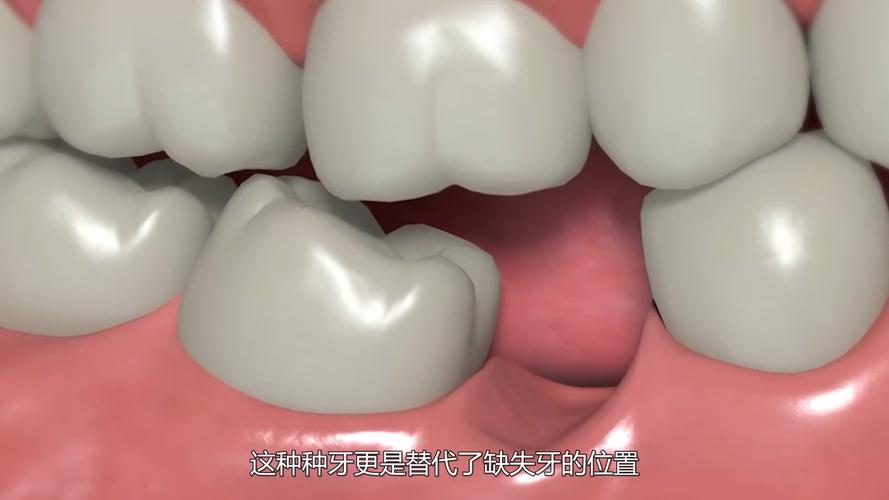 重庆种牙到底疼不疼？一篇说清楚植牙真相