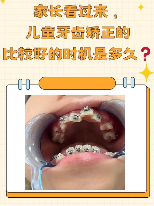 牙齿矫正过早的坏处_牙齿矫正越早做越好吗_8岁做牙齿矫正会不会太早