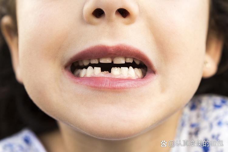 重庆8岁孩子牙齿矫正哪种方法好