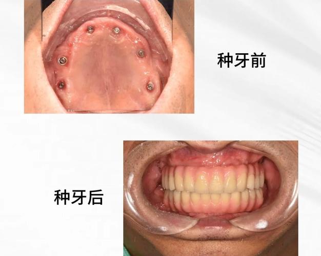 重庆全口种植牙手术到底怎么做
