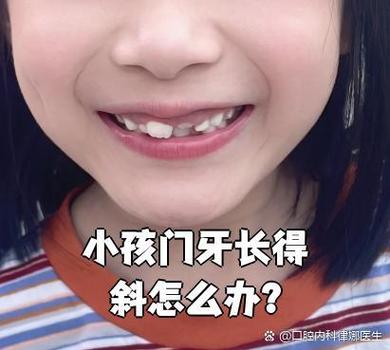 重庆深圳孩子换牙门牙乱长怎么办？专业干预攻略
