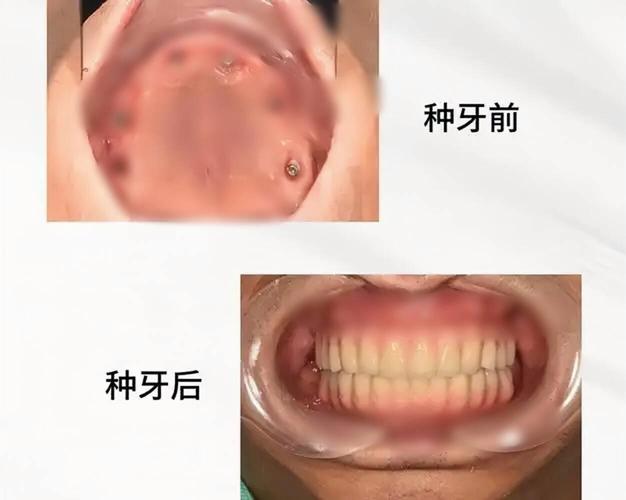 重庆70多岁还能种牙吗？种牙风险大不大？